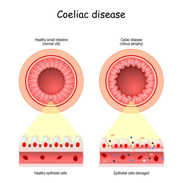Celiac (Gluten) Disease Panel